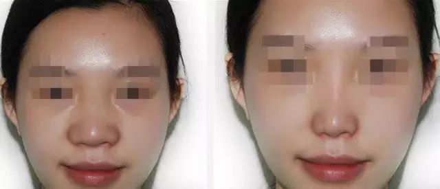 哈爾濱哪家醫(yī)院做隆鼻好？醫(yī)療技術(shù)排行幫你快速選擇