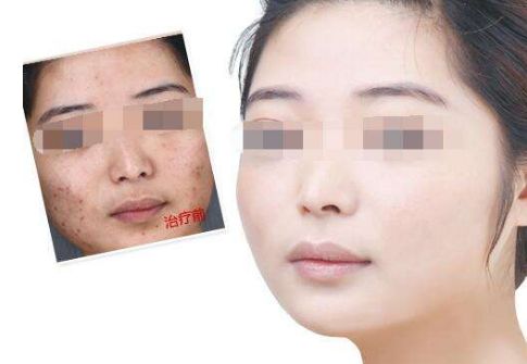 廣州肚皮上的妊娠紋如何有效修復(fù)？