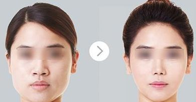 青島王彥進(jìn)雙眼皮手術(shù)案例分享，一覽坐診信息