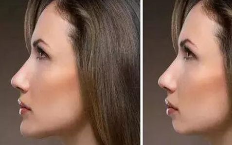 成都哪家醫(yī)院的肋骨鼻修復(fù)效果好？推薦幾位專業(yè)的鼻修復(fù)醫(yī)生