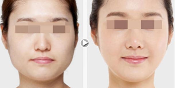 懷化哪家脂肪填充整形醫(yī)院口碑好？前八測(cè)評(píng)曝光！