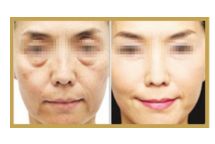 日照哪家醫(yī)院做雙眼皮手術技術高效？