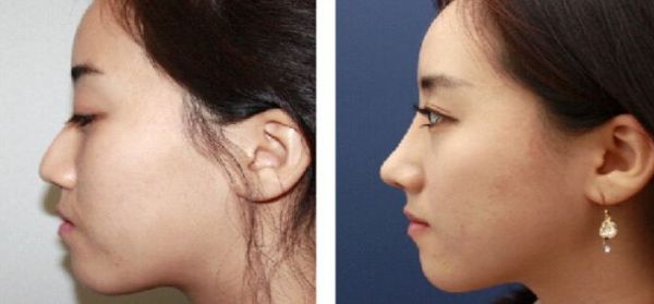 北京大腿抽脂專家推薦，哪個(gè)醫(yī)院技術(shù)好？