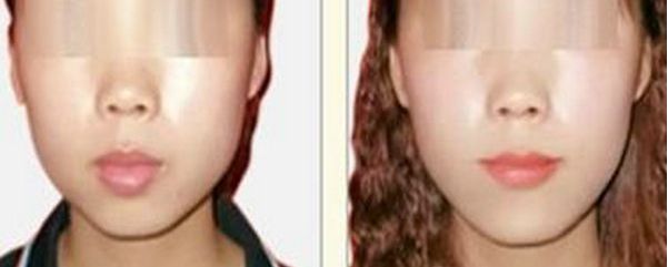 深圳哪家醫(yī)院祛斑效果較好？