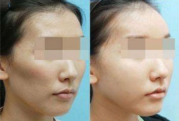 合肥哪兒可以做有效果的光子嫩膚？