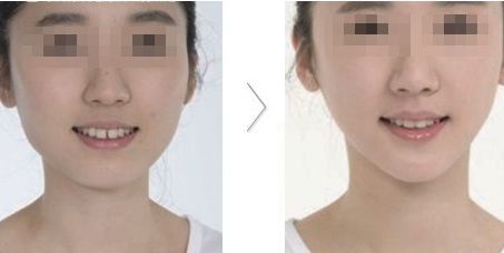 上海哪家醫(yī)生做雙眼皮好？3位口碑佳，美眼選擇就靠他們！