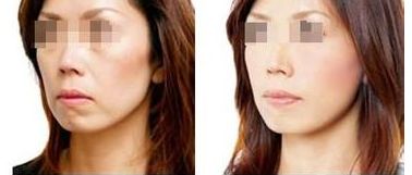 2024珠海雙眼皮手術醫(yī)院推薦，幫您預測前五家