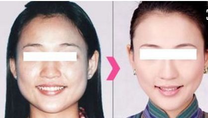 貴陽(yáng)哪家醫(yī)院做自體脂肪豐蘋果肌比較好