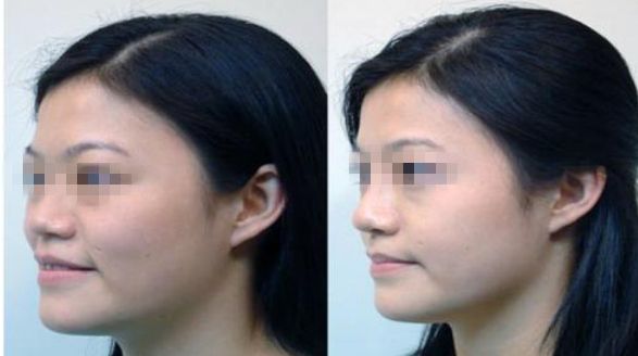 佛山第一人民醫(yī)院抽脂手術(shù)詳解