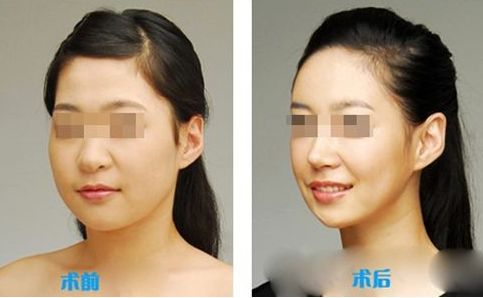 肌功能矯治，哪個階段適合兒童早期干預(yù)？哪些醫(yī)院堪稱專家？