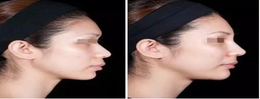 廣州哪家整形醫(yī)院祛痘效果比較好？去痘患者首選醫(yī)院排行榜