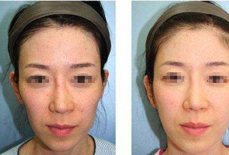 沈陽鼻整形醫(yī)院排名前5，專家推薦！