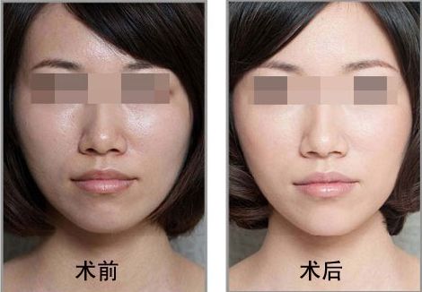 佛山哪家整形醫(yī)院是喬雅登個人推薦的Top7