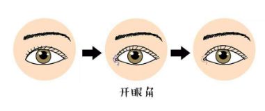 如何選擇適合自己的雙眼皮手術(shù)方法？