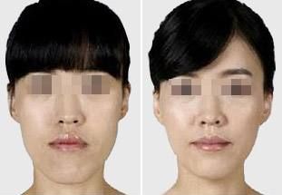 濟南最好的雙眼皮手術醫(yī)院推薦