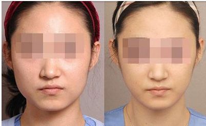 蘭州鼻子整形效果如何？