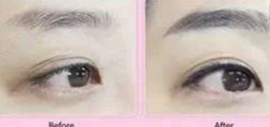 快速消腫！雙下巴吸脂術(shù)后恢復(fù)時(shí)長揭秘