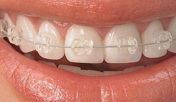 國產(chǎn)玻尿酸品牌大揭秘！海薇、潤百顏、愛芙萊等十大品牌全解析