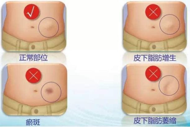 獲悉四川地區(qū)專業(yè)自體脂肪隆胸醫(yī)院，解決您的疑慮