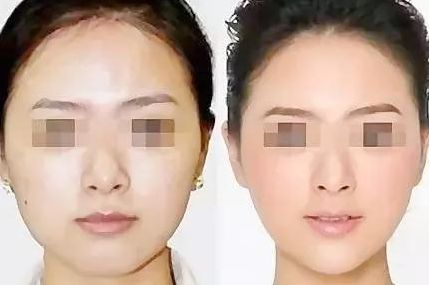 長沙哪個醫(yī)院做雙眼皮最好？