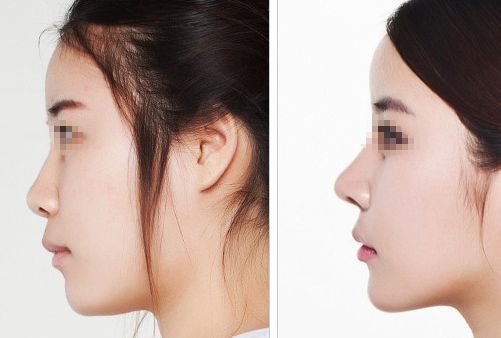 汕頭名流整形醫(yī)院：拉雙眼皮、吸脂價(jià)格一覽，專(zhuān)家解讀真實(shí)案例