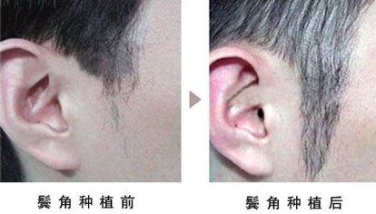 開眼角手術(shù)改善眼型，揭秘適合人群