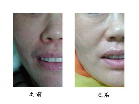 長(zhǎng)沙手術(shù)消除妊娠紋醫(yī)生