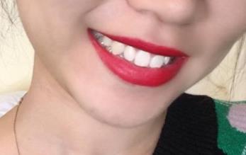 南京去除動(dòng)態(tài)細(xì)紋皺紋醫(yī)生