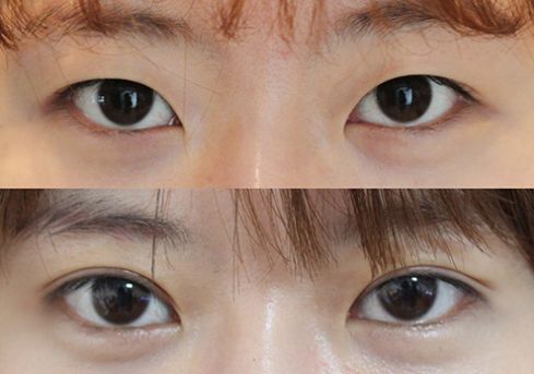 株洲填充祛生長紋醫(yī)生