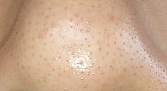 承德自體脂肪填充塑型醫(yī)生