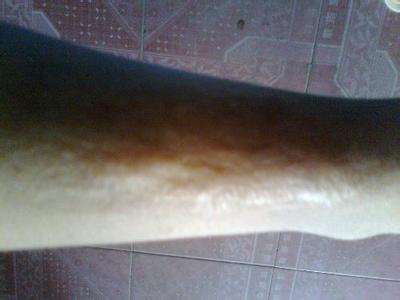 廣州手術(shù)矯正乳房下垂醫(yī)生