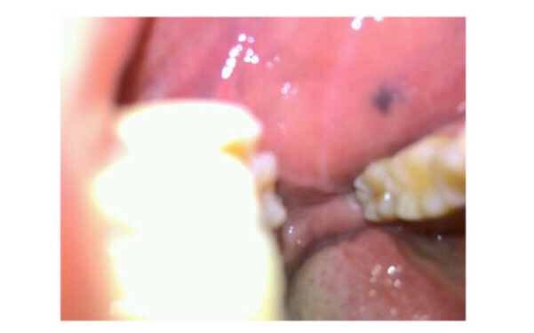 寧波飛梭點(diǎn)陣激光醫(yī)生