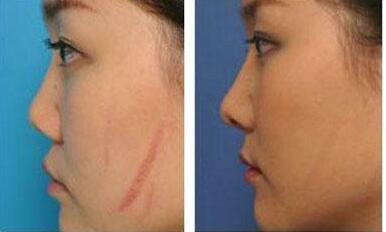 長沙水動力吸脂醫(yī)生