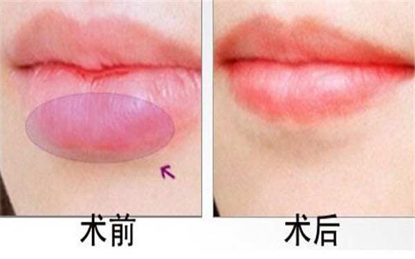 臺(tái)州超聲刀祛除妊娠紋醫(yī)生