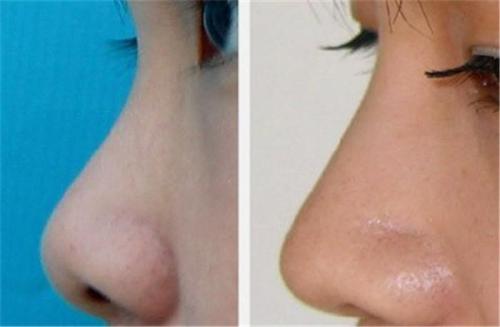 商丘玻尿酸用于隆胸醫(yī)生