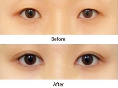 廊坊分層祛痘美膚術醫(yī)生