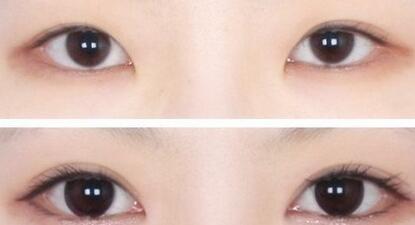 淄博手術(shù)改善下眼皮皺紋醫(yī)生