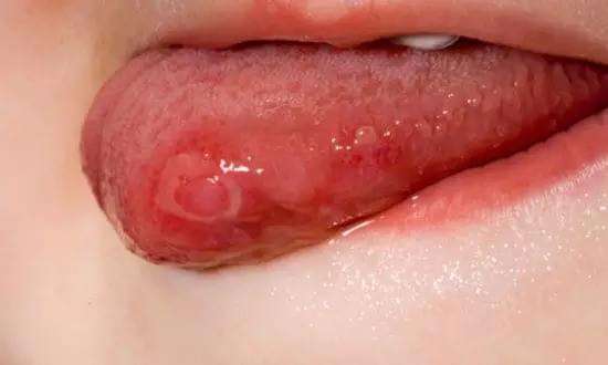 廣東內切眼袋手術醫(yī)生