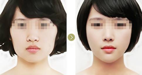 岳陽玻尿酸注射豐臉頰醫(yī)生