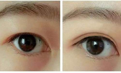 寧波拉皮去除眼睛細(xì)紋醫(yī)生