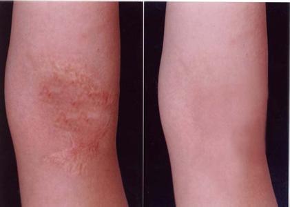 長(zhǎng)沙電波拉皮去頸紋醫(yī)生