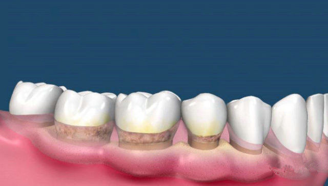 長沙激光溶脂瘦臀醫(yī)生