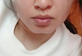 溫州疤痕微創(chuàng)手術(shù)醫(yī)生