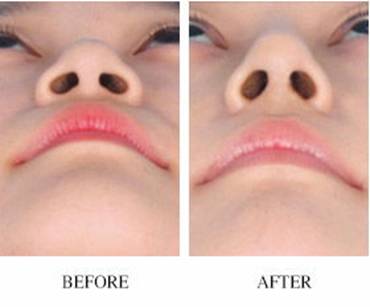 鄭州自體脂肪豐耳垂醫(yī)生