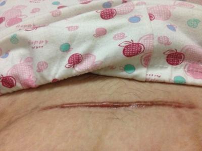 深圳韓國三維豐胸醫(yī)生