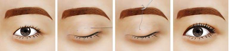 2023年天津公立醫(yī)院雙眼皮手術(shù)排名及網(wǎng)友好評(píng)！