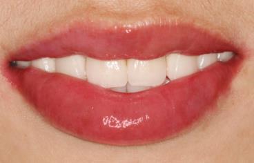 義烏點(diǎn)陣激光祛額頭紋醫(yī)生