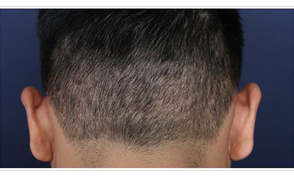 2023年北京豐胸整形排名：綜合評(píng)價(jià)前五強(qiáng)醫(yī)院揭曉！