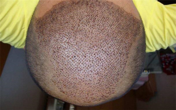 上海頂尖洗紋身院所推薦！排名前六的權(quán)威機構(gòu)一覽！