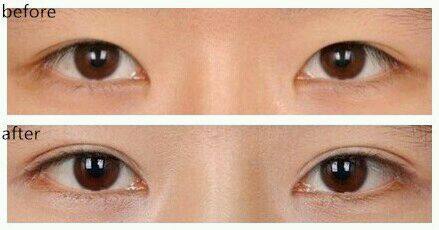 河南微創(chuàng)眉間紋手術(shù)醫(yī)生